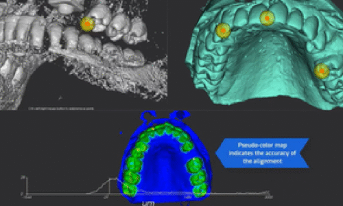 GUIDED SURGERY BASICS