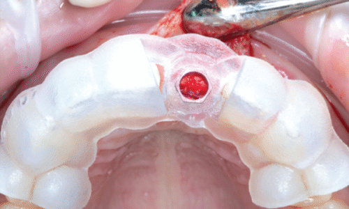 TOOTH SUPPORTED CASE VIDEOS