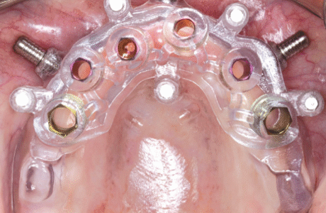 TISSUE SUPPORTED CASE VIDEOS