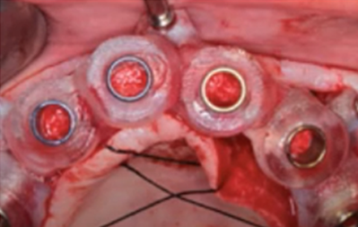 BONE SUPPORTED CASE VIDEOS